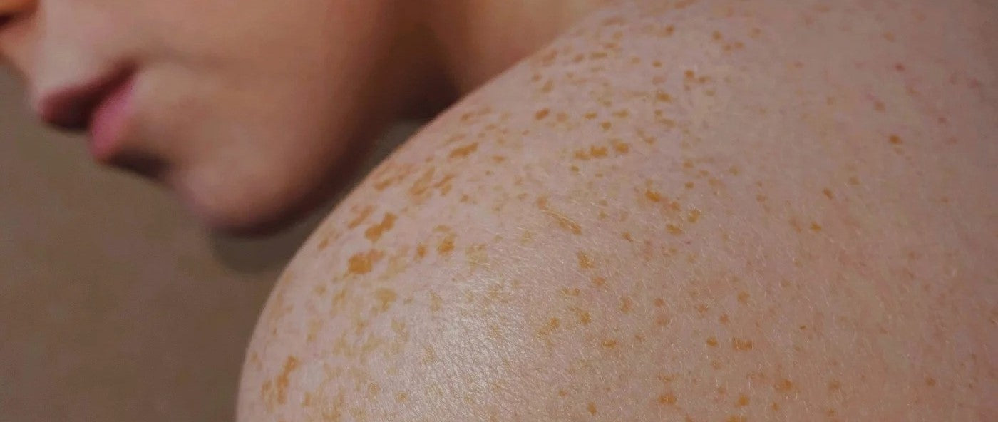 Tudo o que você precisa saber sobre o tratamento de manchas no corpo com Lagarteando Faceira