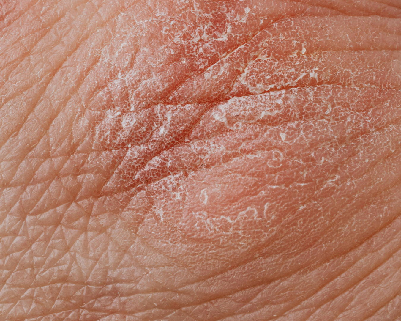 5 sinais de que sua pele está pedindo socorro no frio (e como ajudar)