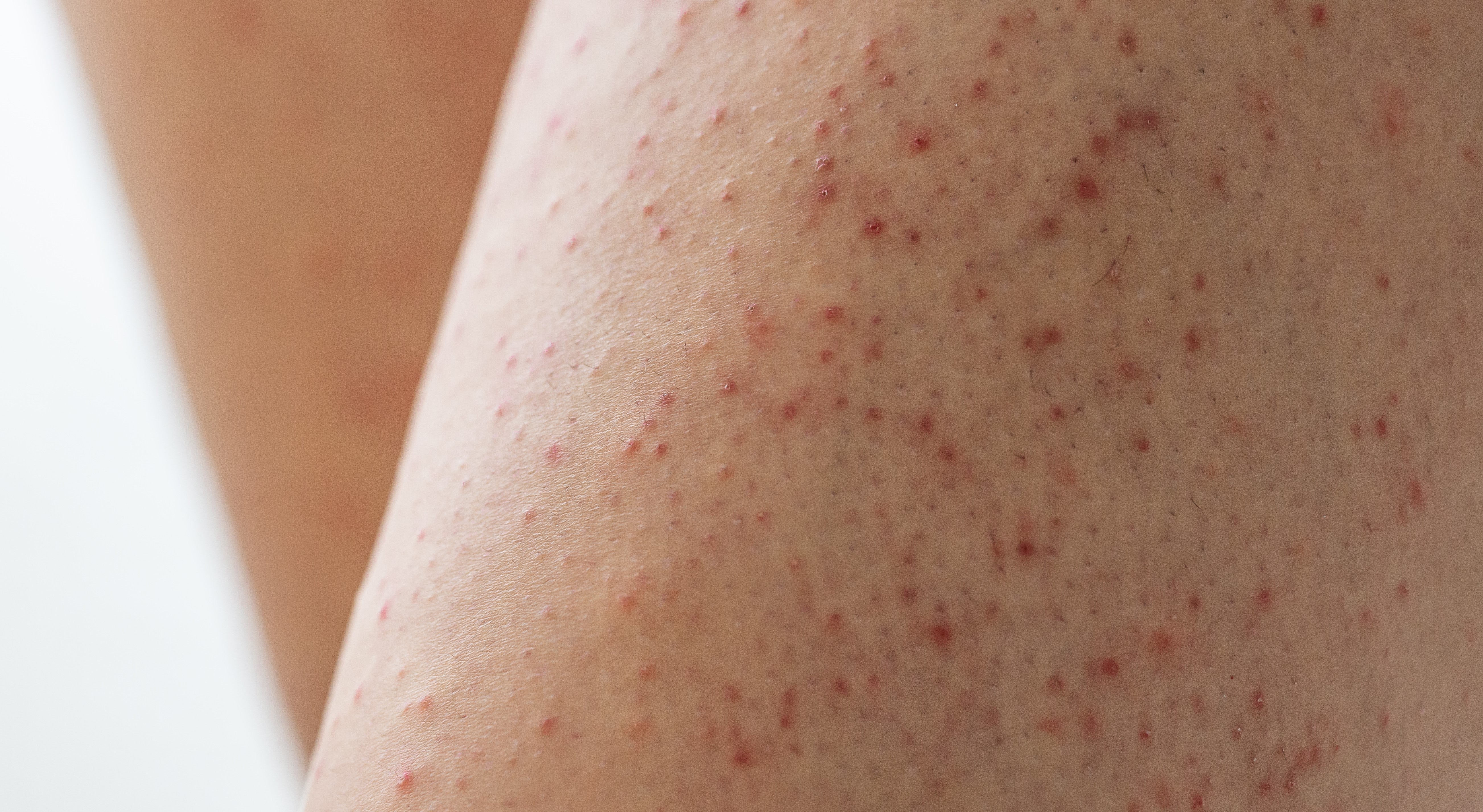 Foliculite corporal: sintomas, causas, prevenção e tratamento