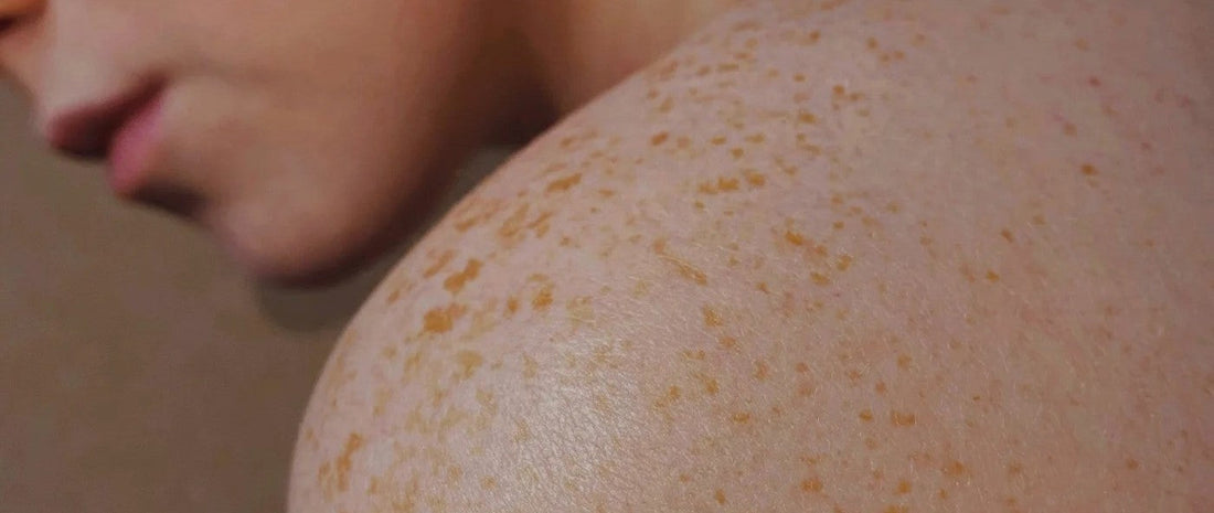 Tudo o que você precisa saber sobre o tratamento de manchas no corpo com Lagarteando Faceira