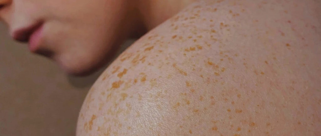 Tudo o que você precisa saber sobre o tratamento de manchas no corpo com Lagarteando Faceira